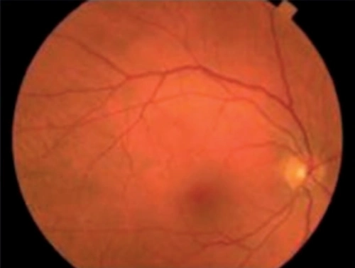 Subclinical AMD (Very Early Stage)