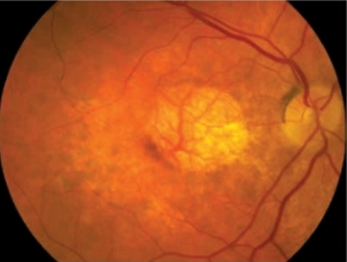 Advanced Dry AMD