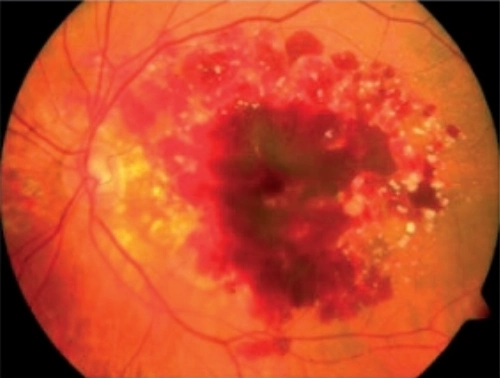 Advanced Wet AMD